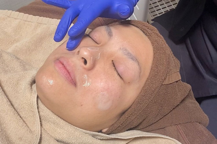 サリチル酸ピーリング